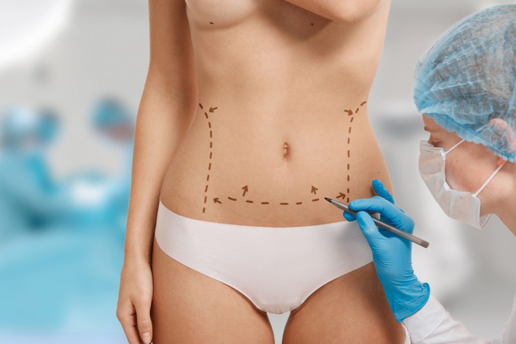 Liposuccion en Tunisie , Liposuccion J-Plasma en Tunisie
