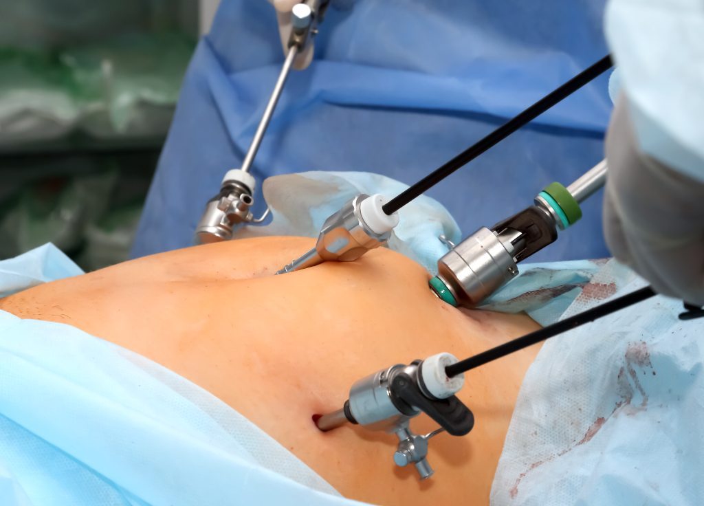 laparascopie gynecologique