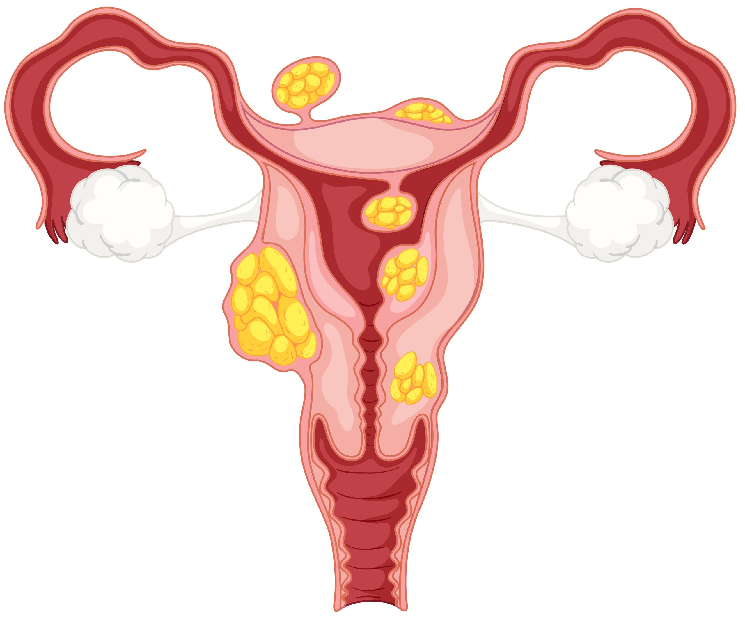 ellever les fibromes- myomectomie tunisie