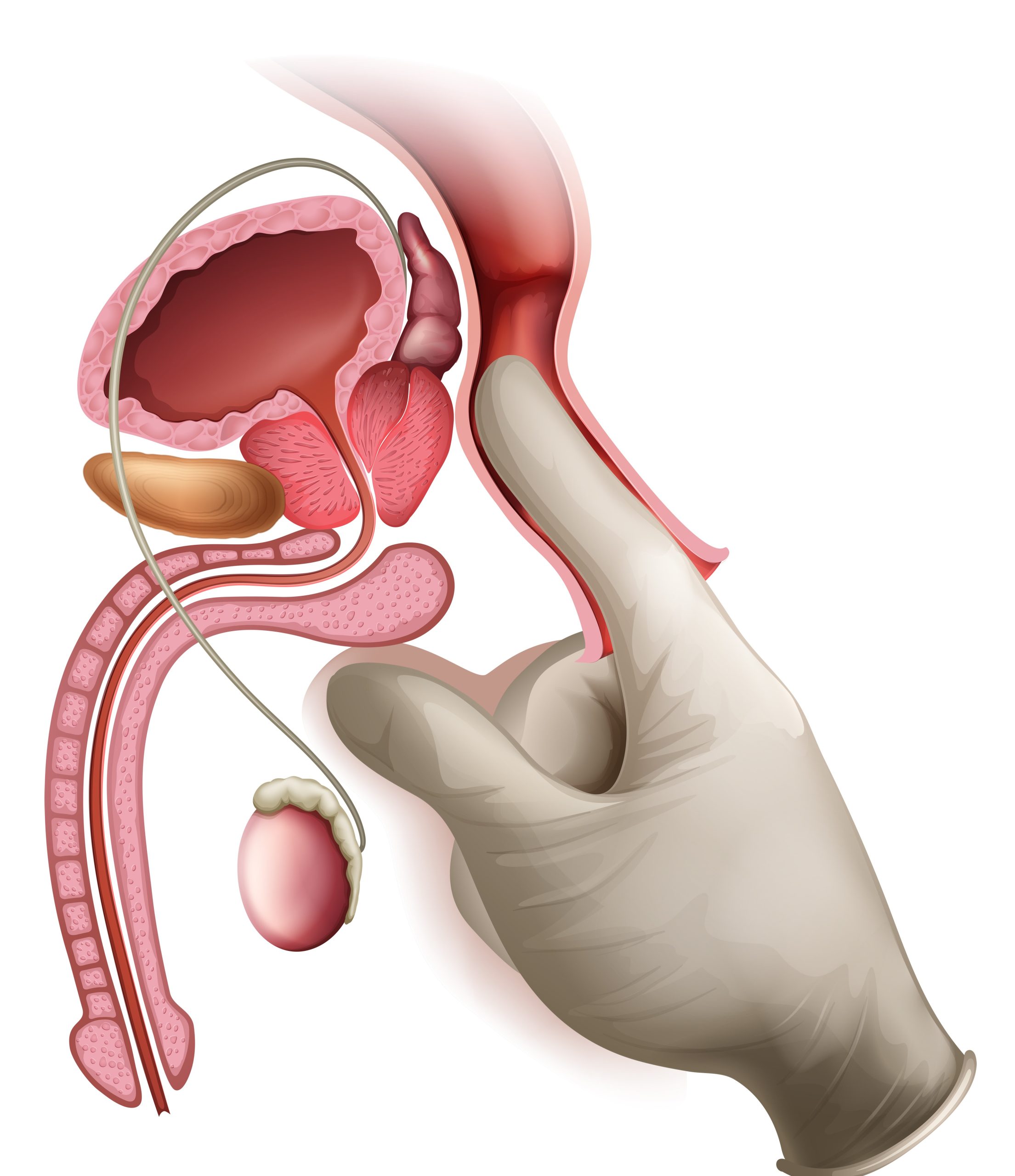 enlever la prostate tunisie