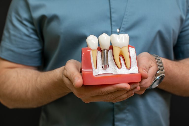 Implants dentaires en Tunisie