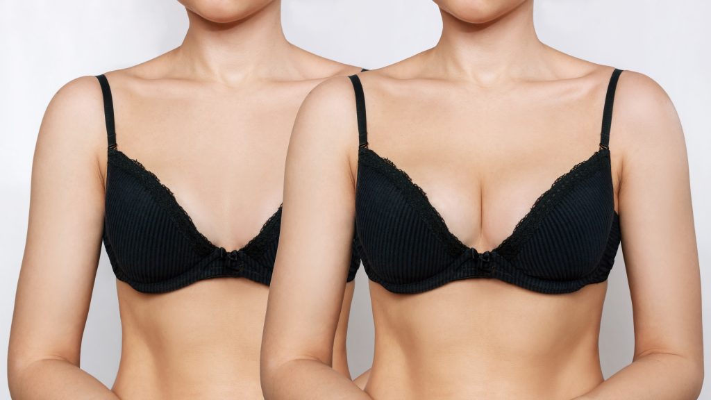 Lifting des seins avec prothèse en Tunisie