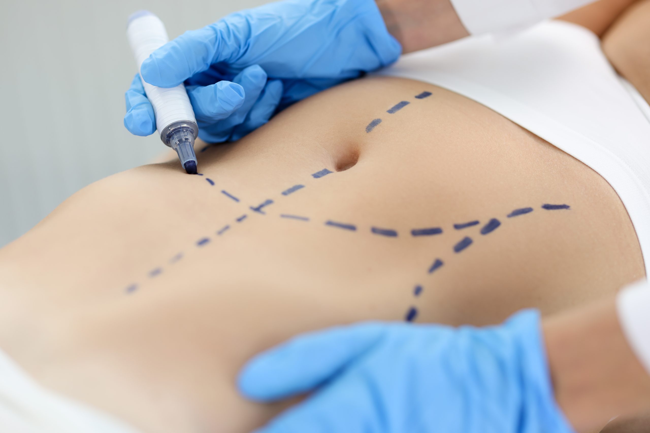 Abdominoplastie Risques en Tunisie