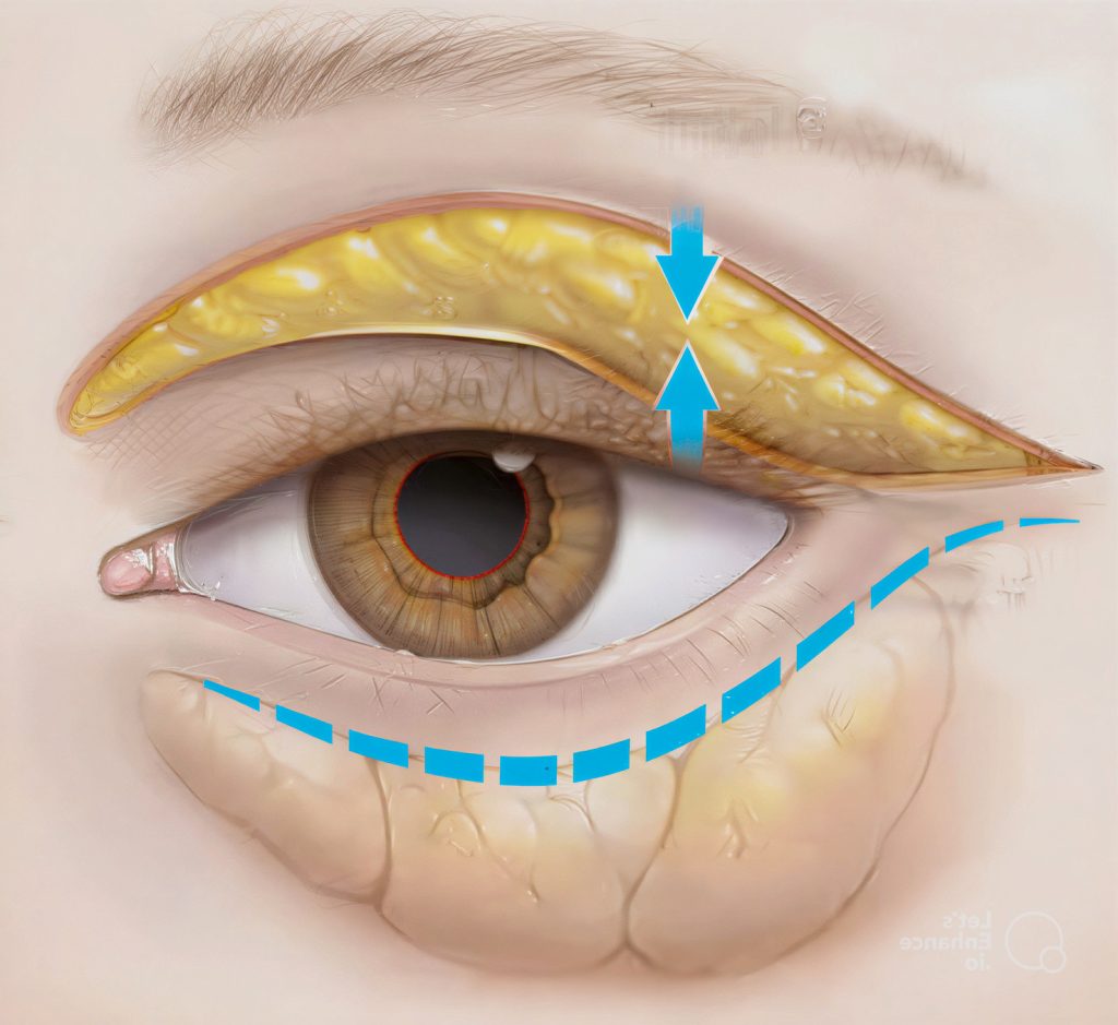 Blépharoplastie en Tunisie