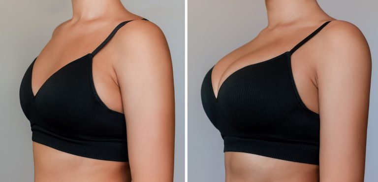 young-tanned-woman-bra-before-after-breast-augmentation-with-silicone-implants