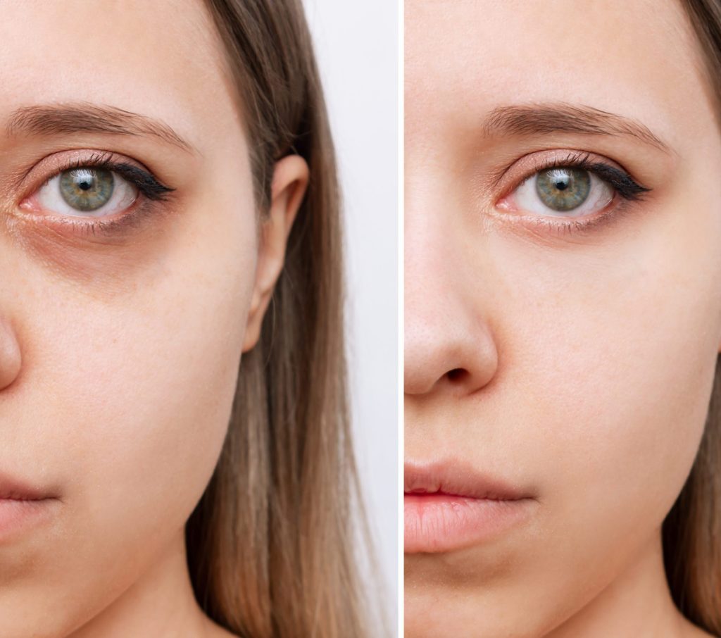 Blépharoplastie en Tunisie