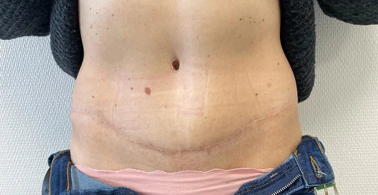 Abdominoplastie en Tunisie