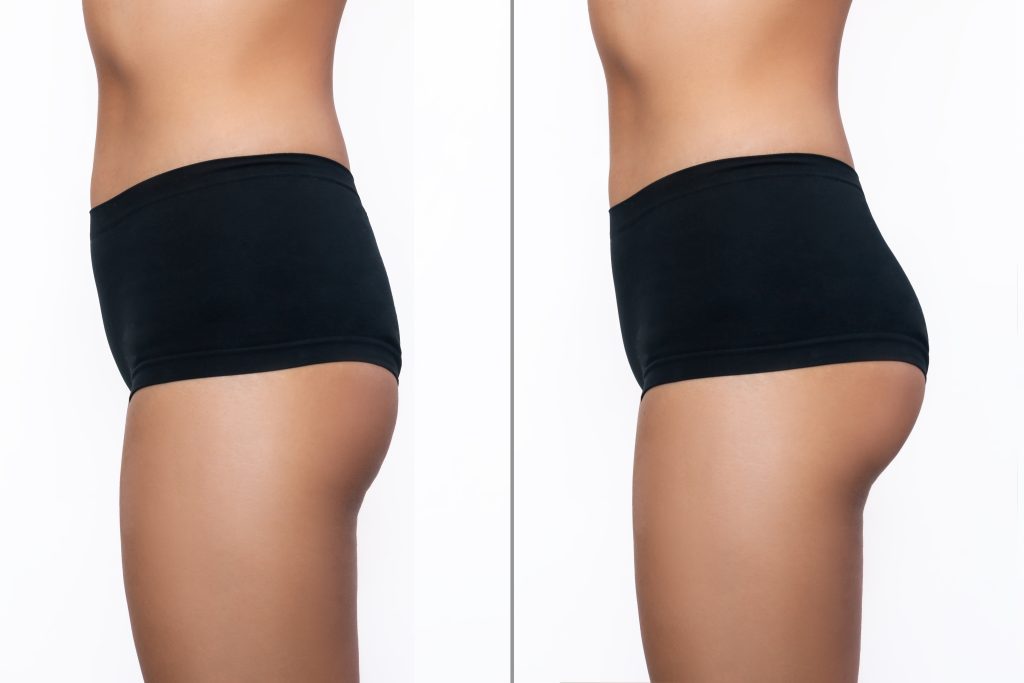 Brazilian Butt Lift en Tunisie