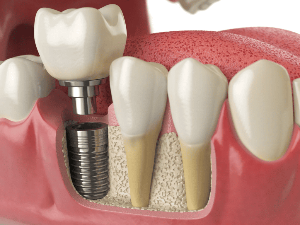Implants dentaires en Tunisie