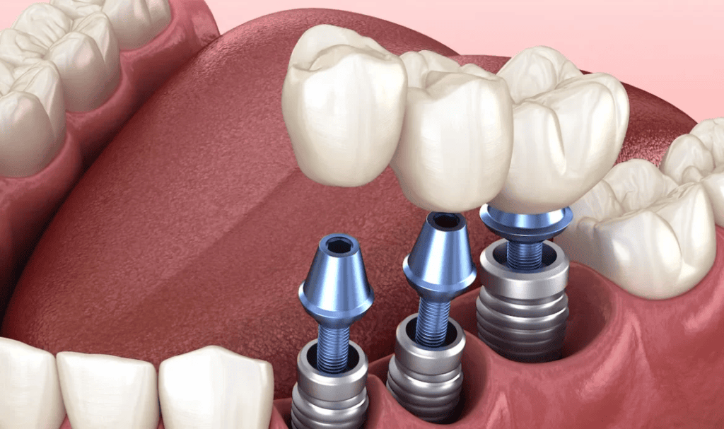 Implants dentaires en Tunisie