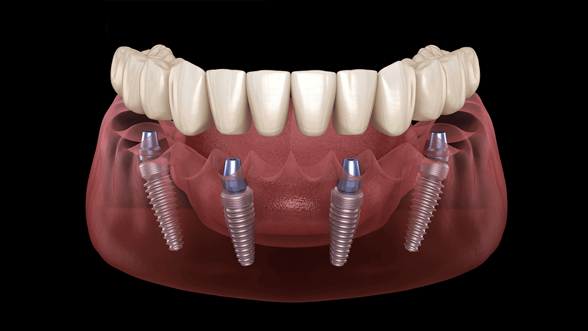 Implants dentaires en Tunisie all on 4
