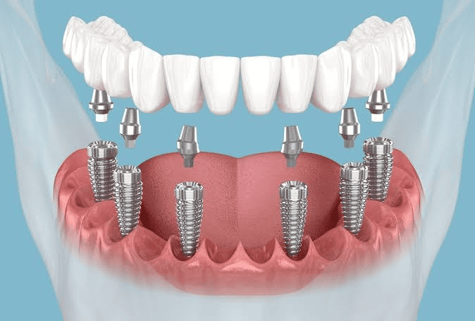 Implants dentaires en Tunisie