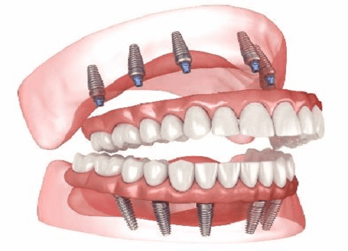 Implants dentaires en Tunisie