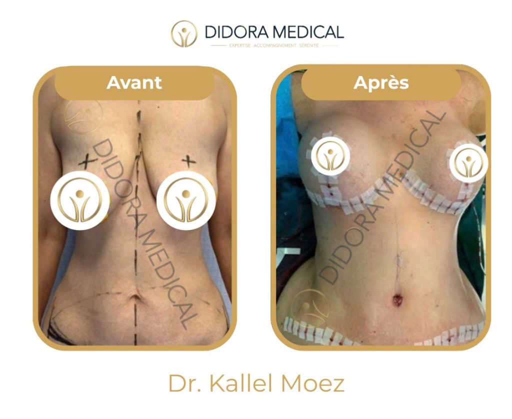 résultat avant après lifting seins avec prothèses
