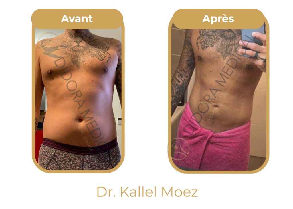 Liposuccion-vaser-ventre-avant-apres-didora.jpg