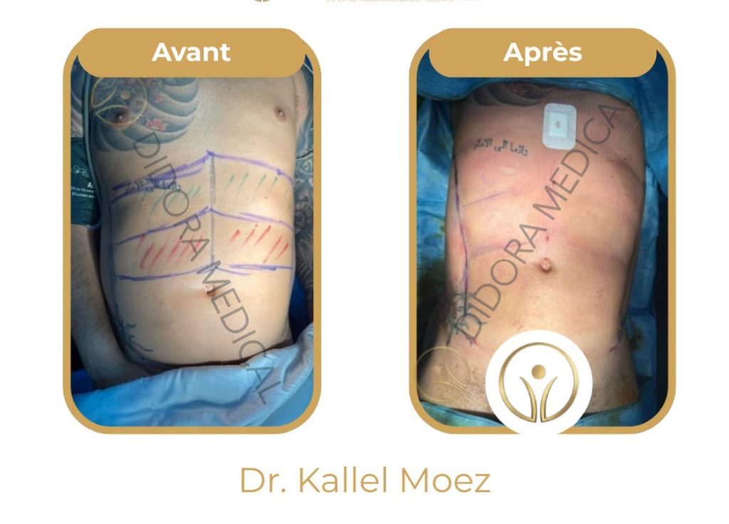 Liposuccion-vaser-ventre-avant-apres-didora.jpg