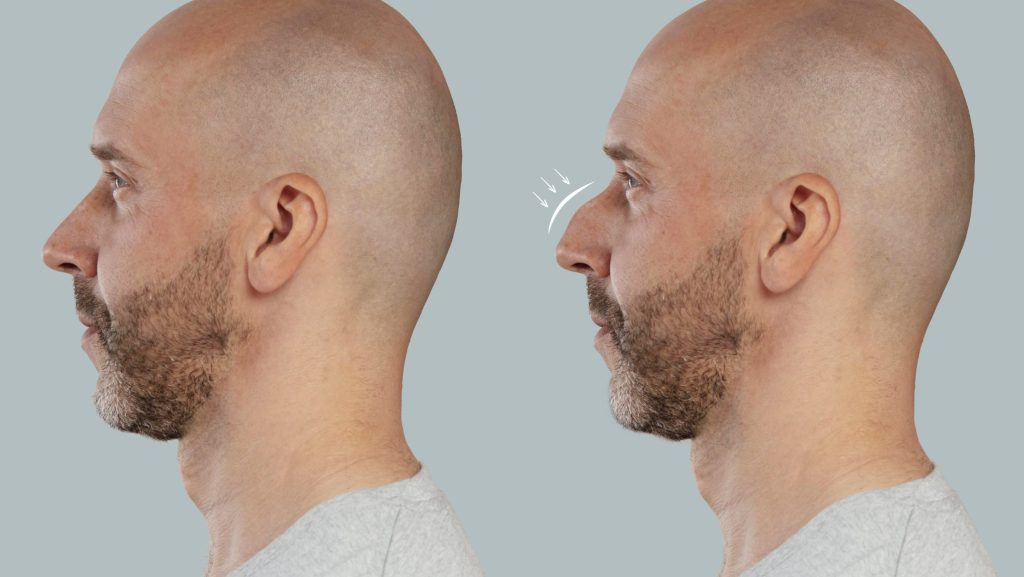 avant apres rhinoplastie homme