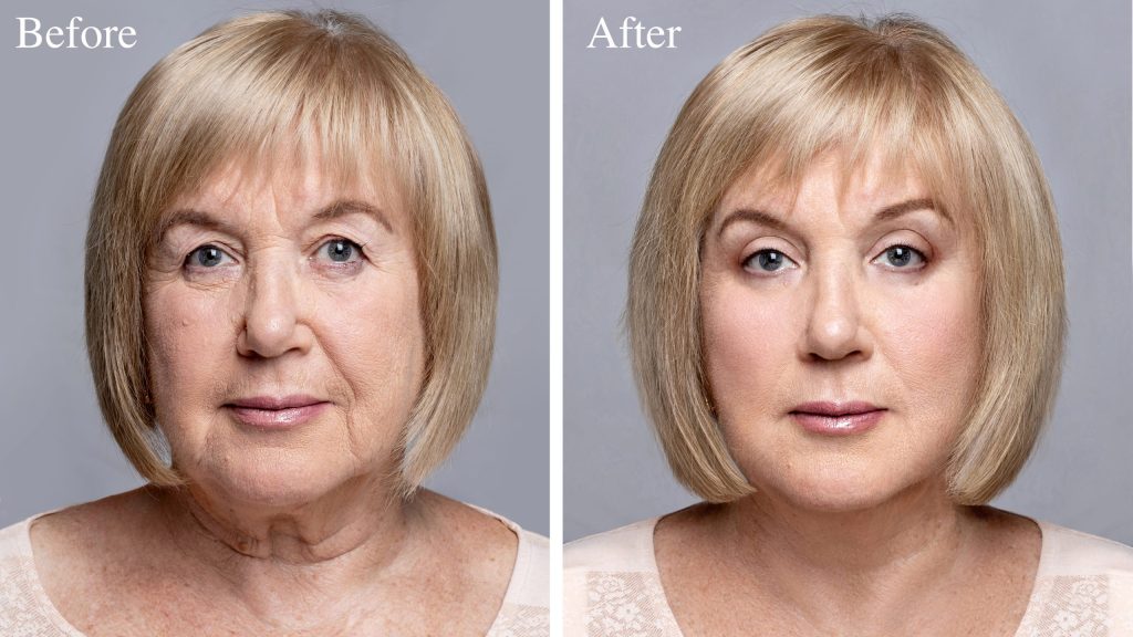 Lifting du visage, résultat naturel