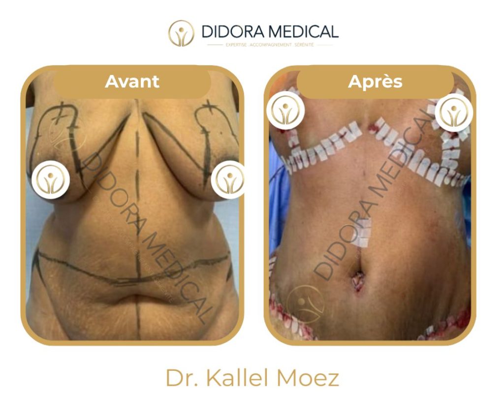 lifting-des-seins-avant-apres-abdominoplasie en Tunisie.jpg