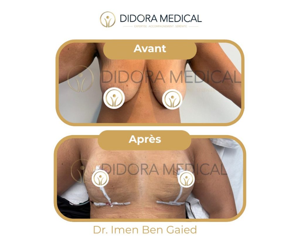 lifting-des-seins-avant-apres-Tunisie.jpg